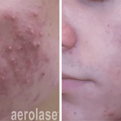 Another Acne Treatment with Aerolase