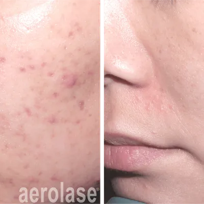 Acne Treatment with Aerolase