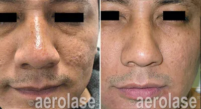 Anti-Aging Treatment with Aerolase