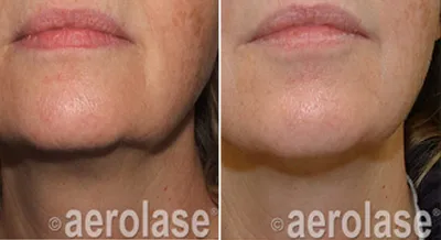 Another Anti-Aging Treatment with Aerolase