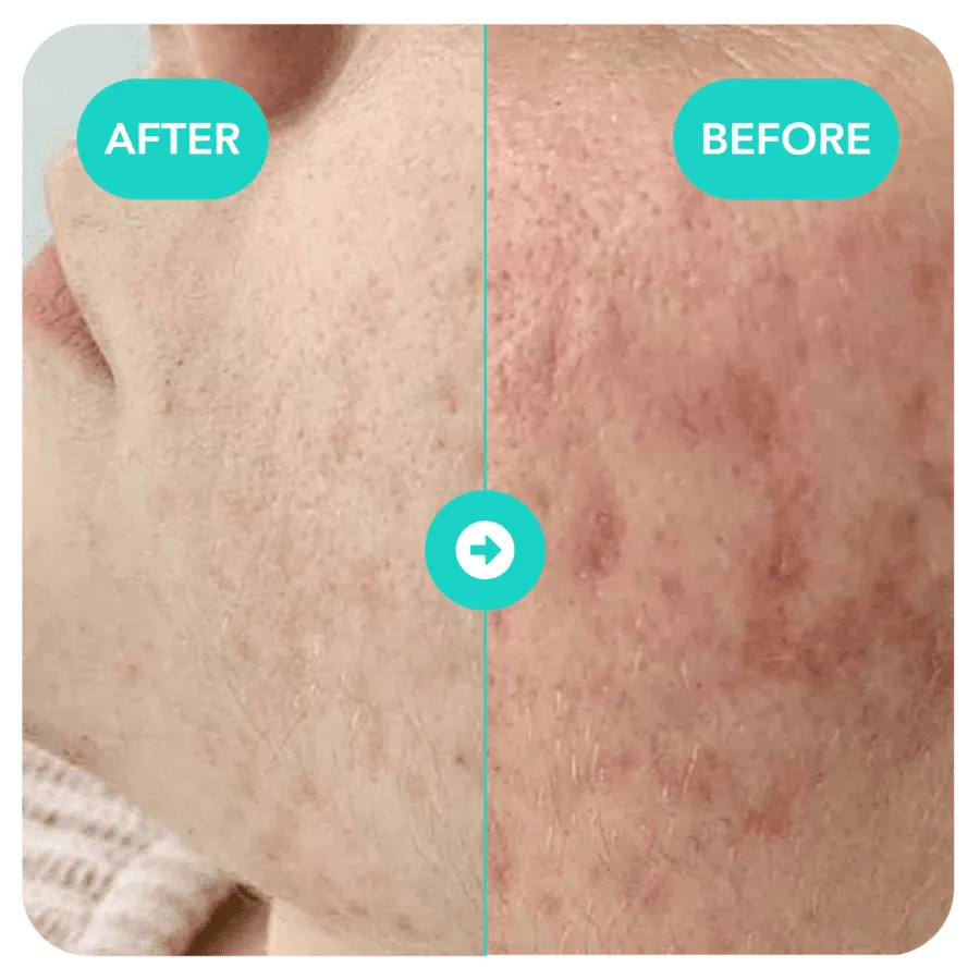 Before and after BioRePeel treatment