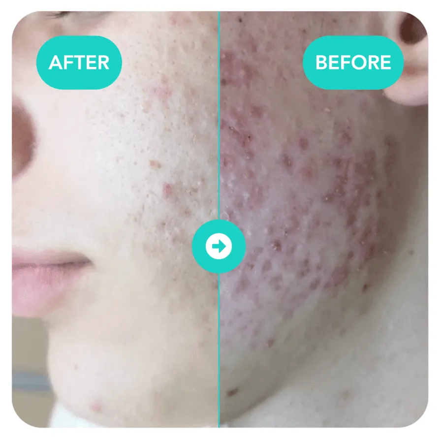 Before and after Lucente treatment