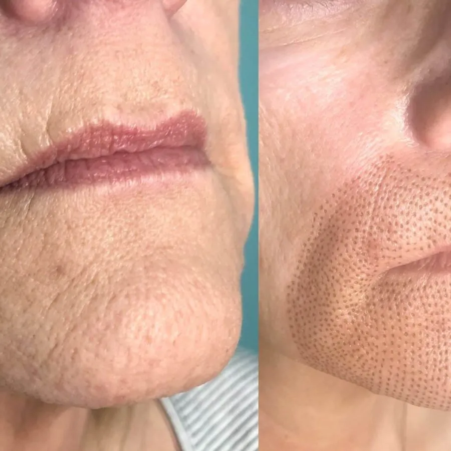 Before and after Plasma Fibroblast treatment 1