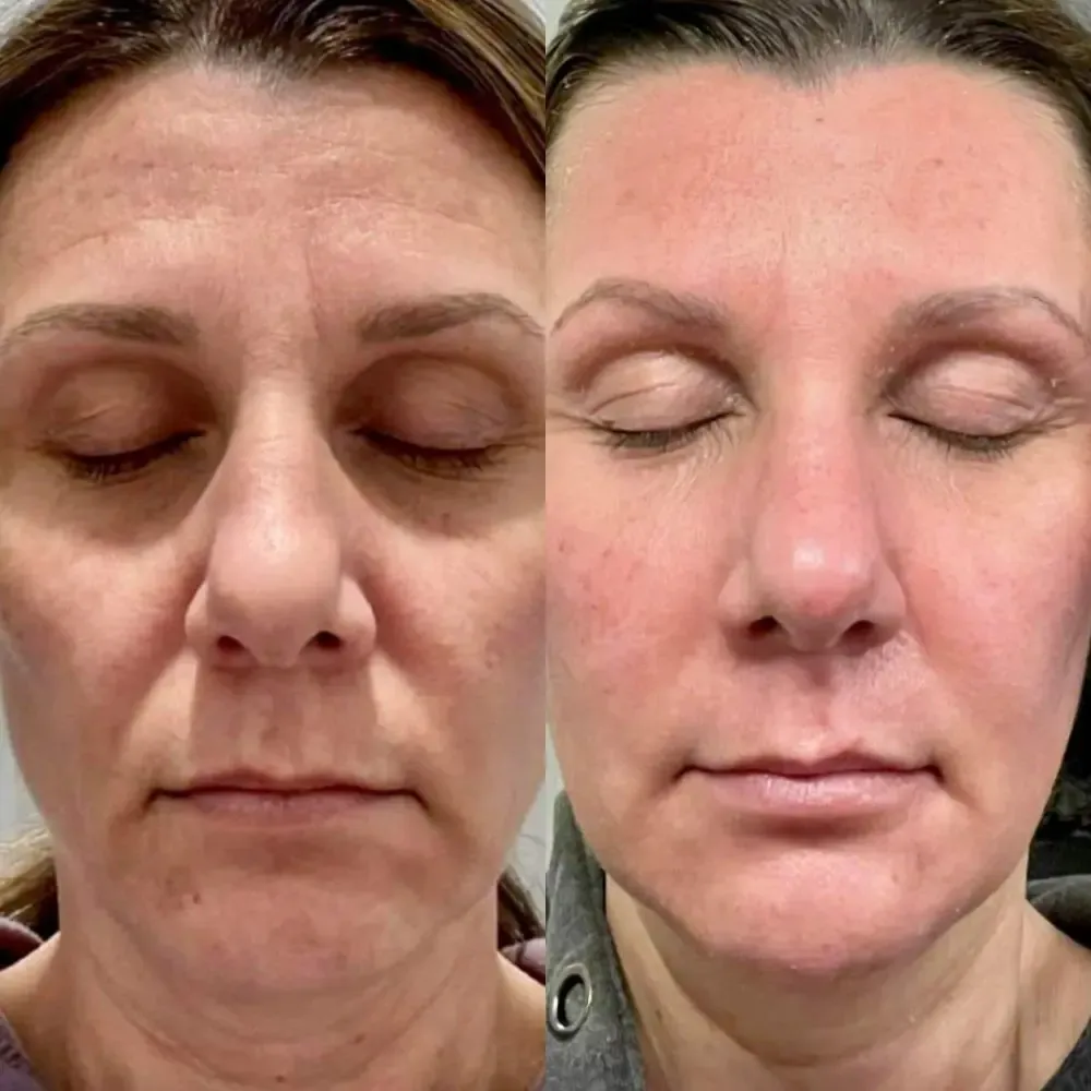 Jet plasma treatment before and after - Face 1