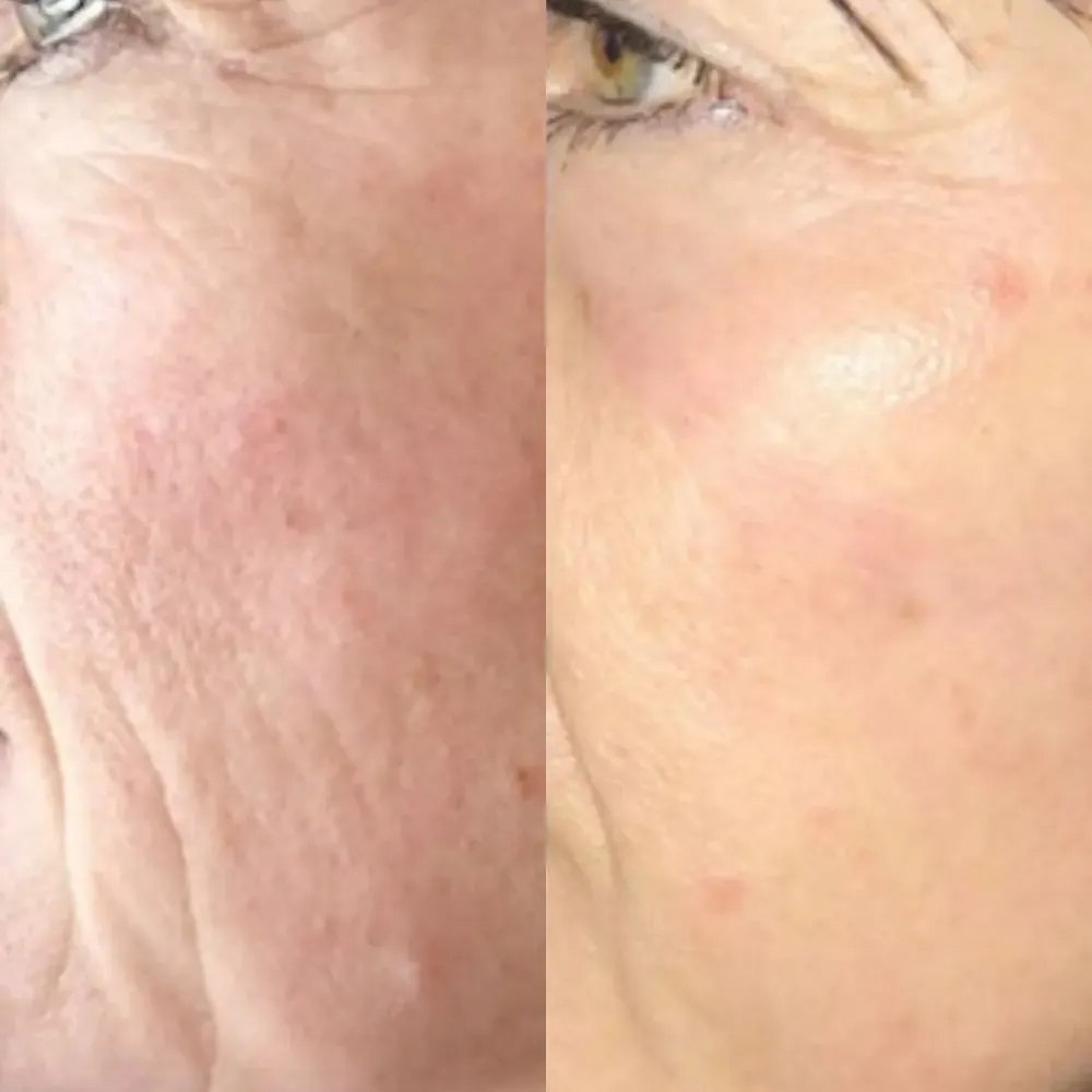 Jet plasma treatment before and after - Face 2