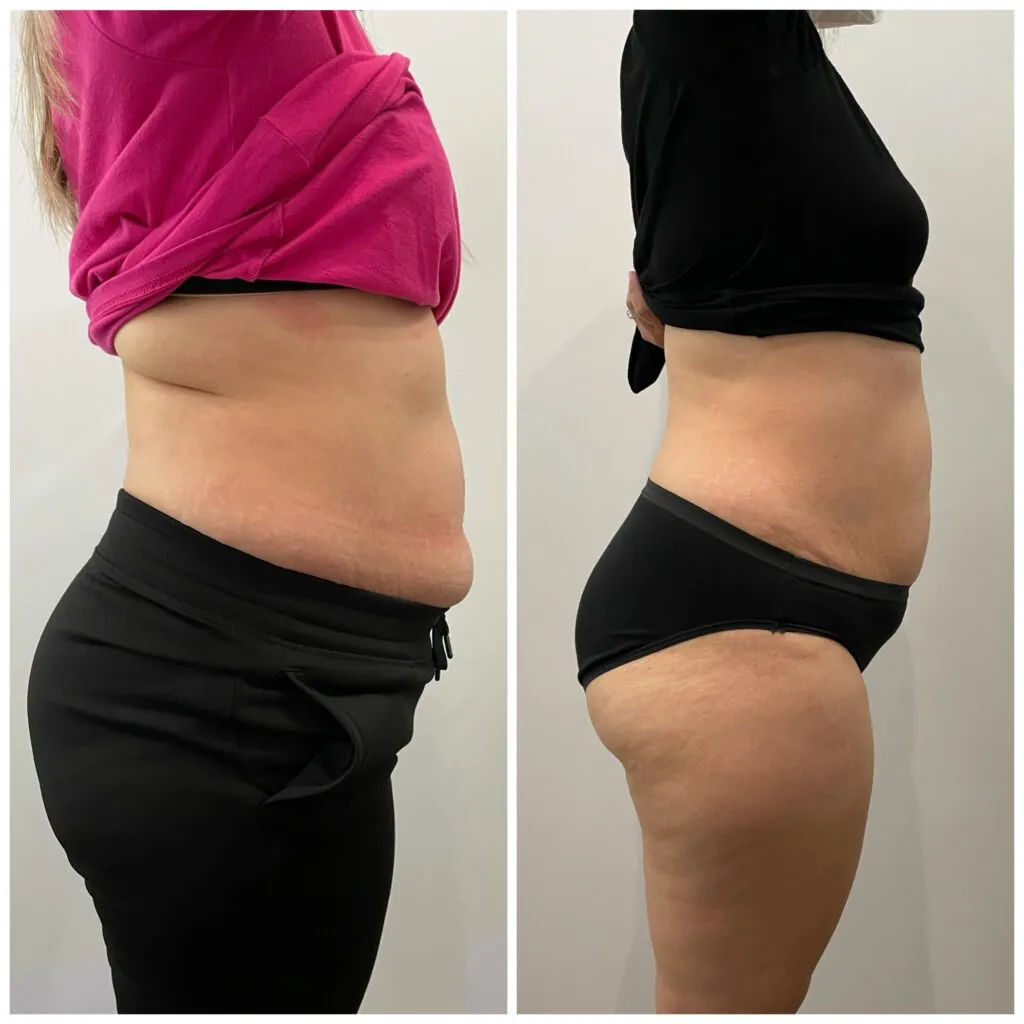 Before and after Endospheres body treatment