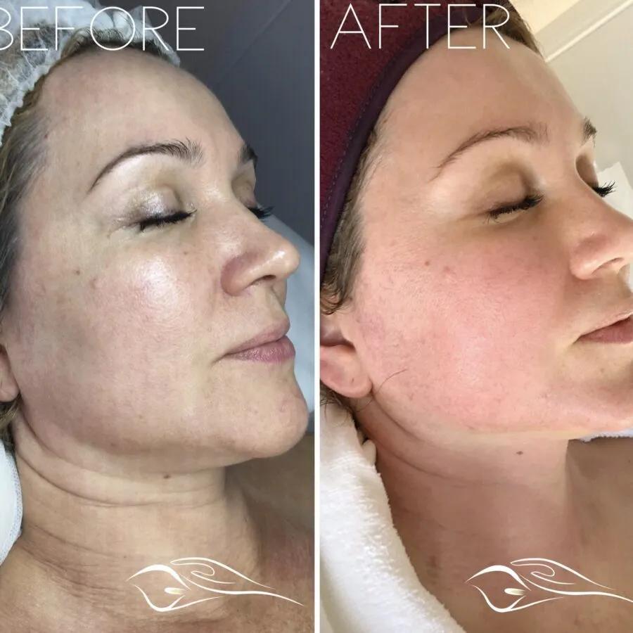 Before and after Plasma Fibroblast treatment 3