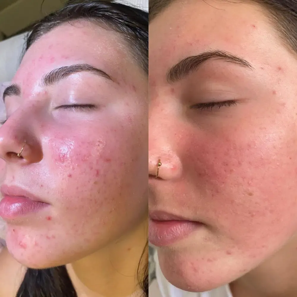 Jet plasma treatment before and after - Face 3