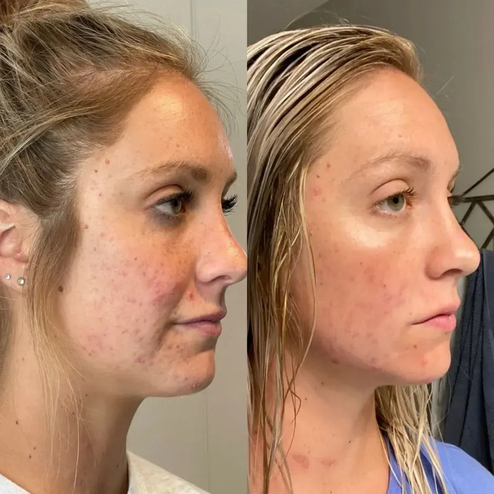 Jet plasma treatment before and after - Face 4