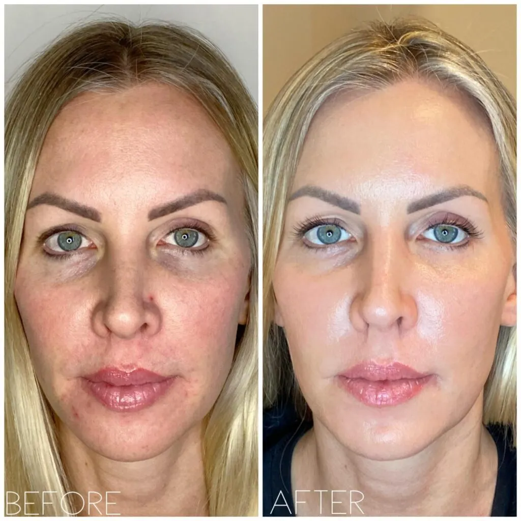 Before and after Plasma Fibroblast treatment 4