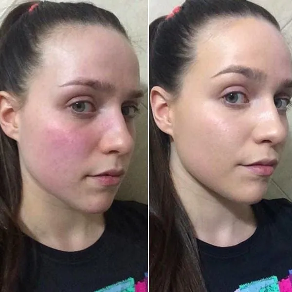 Before and after skin care treatment 1