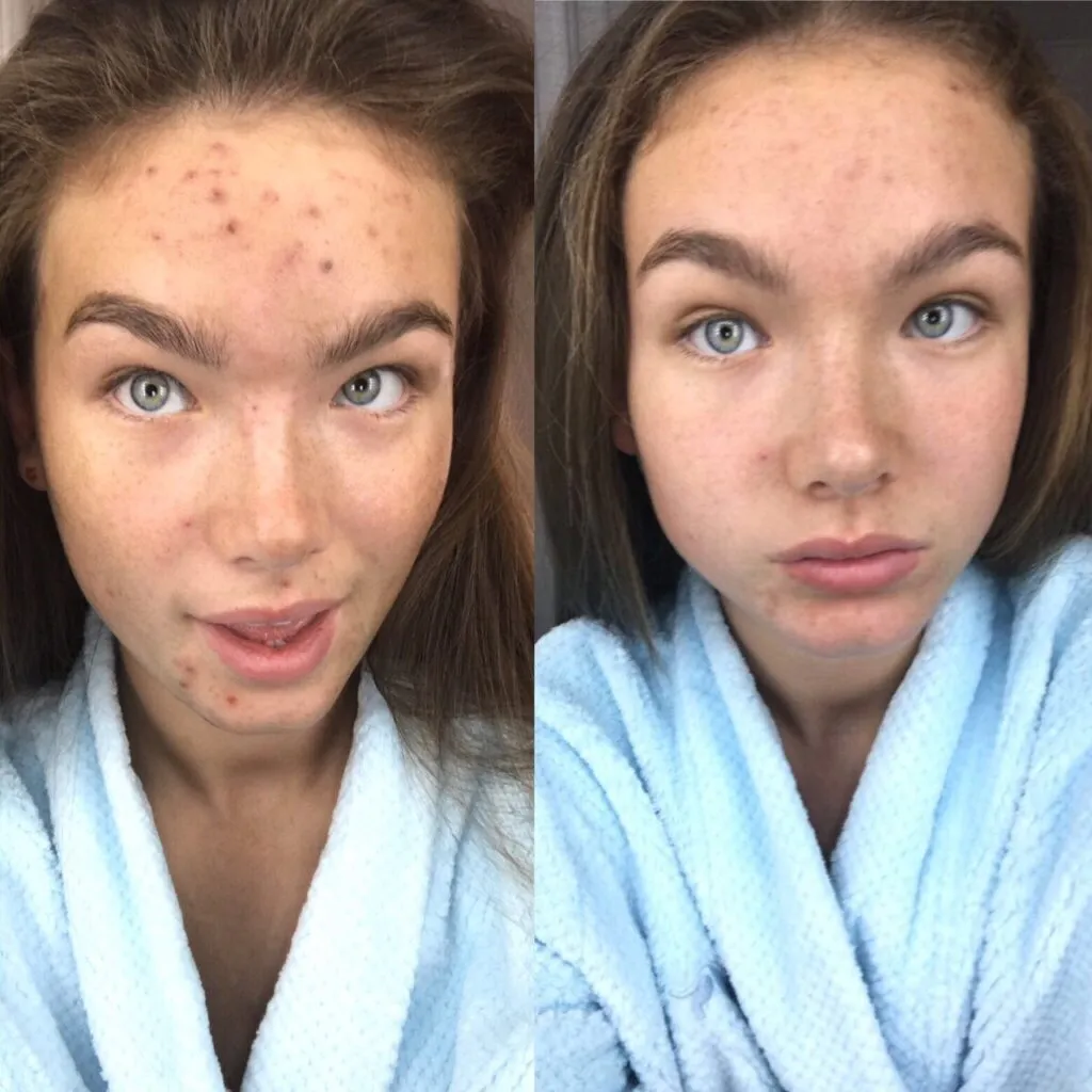 Before and after skin care treatment 2