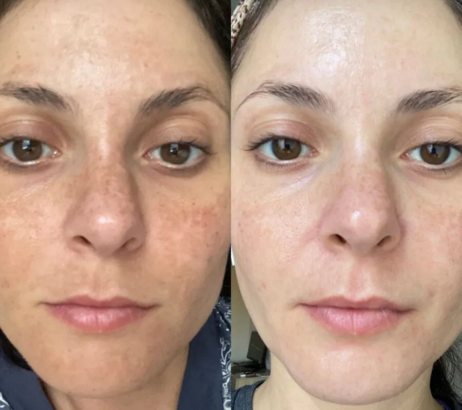 Before and after skin care treatment 4