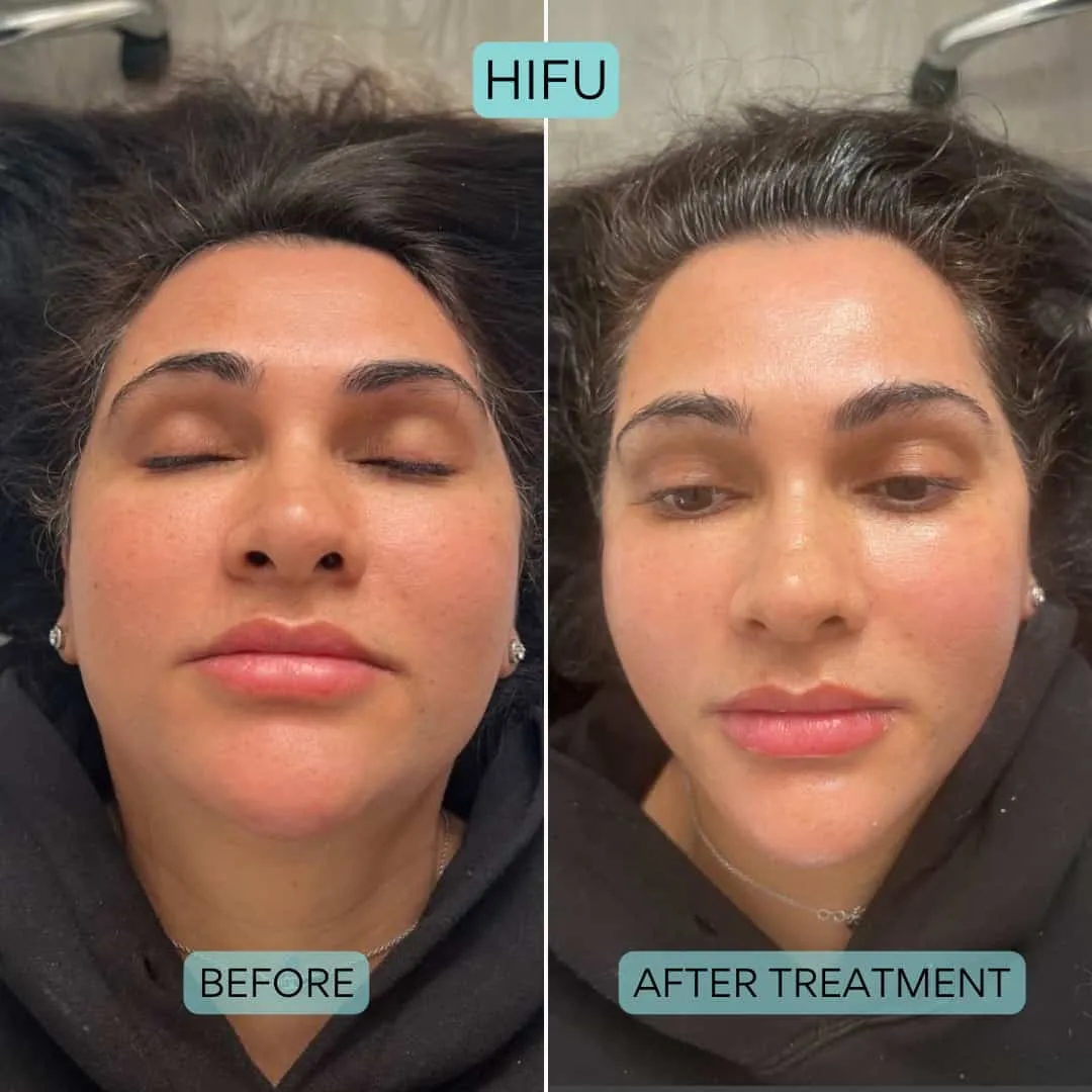 Before and after HIFU treatment 2