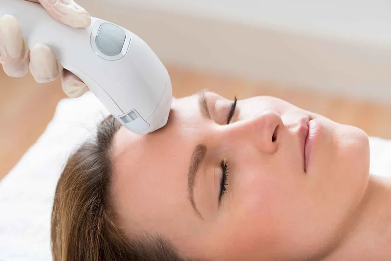 IPL (Intense Pulsed Light) treatment