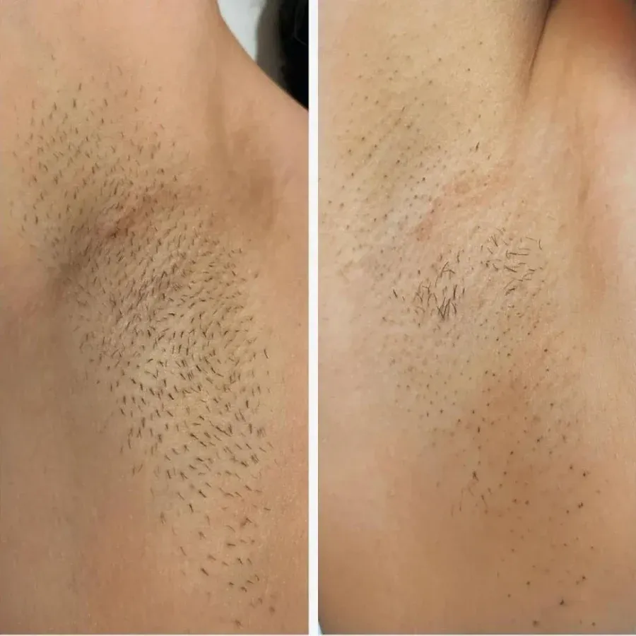 Before and after laser hair removal treatment 1