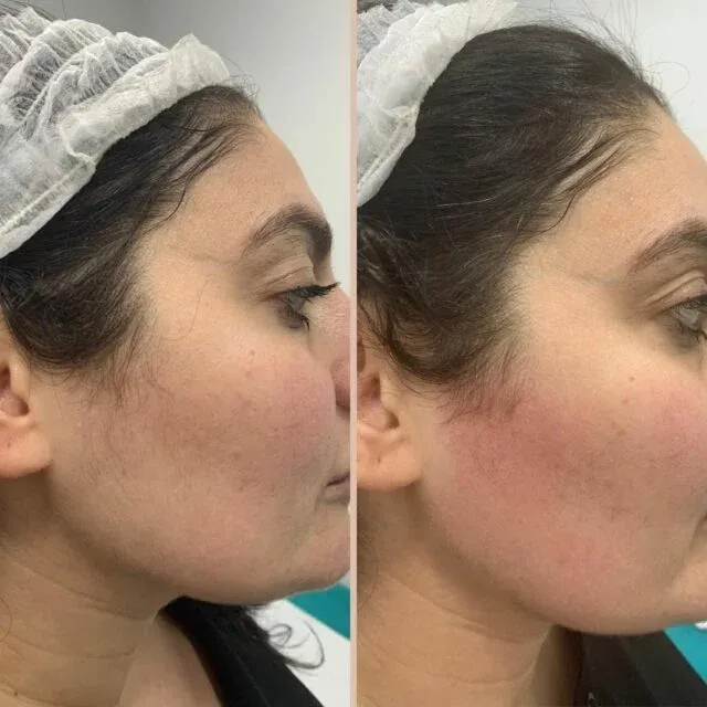 Before and after laser hair removal treatment 2