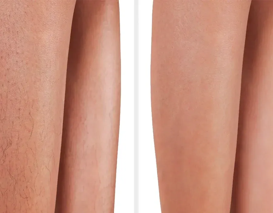 Before and after laser hair removal treatment 3