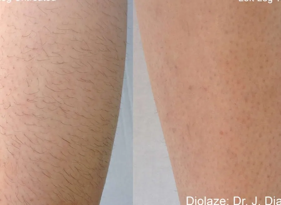 Before and after laser hair removal treatment 4