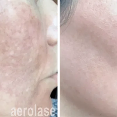 Pigmentation Treatment with Aerolase