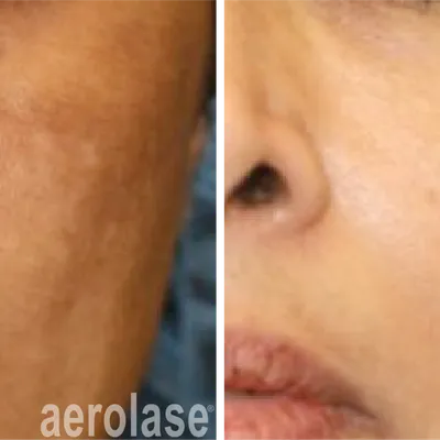 Another Pigmentation Treatment with Aerolase