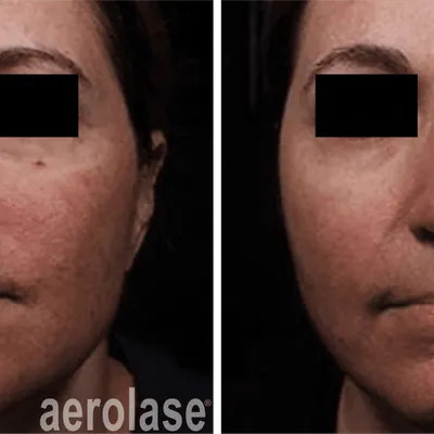 Rosacea Treatment with Aerolase