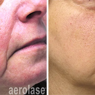 Another Rosacea Treatment with Aerolase